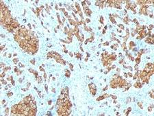 MLANA / Melan-A Antibody - Formalin-fixed, paraffin-embedded human melanoma stained with anti-Melan-A antibody (SPM342).  This image was taken for the unmodified form of this product. Other forms have not been tested.