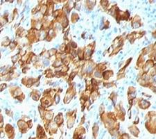 MLANA / Melan-A Antibody - Formalin-fixed, paraffin-embedded human melanoma stained with anti-MART-1 antibody (SPM540).  This image was taken for the unmodified form of this product. Other forms have not been tested.