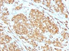 MLANA / Melan-A Antibody - Formalin-fixed, paraffin-embedded human melanoma stained with Melan-A antibody (SPM555).  This image was taken for the unmodified form of this product. Other forms have not been tested.