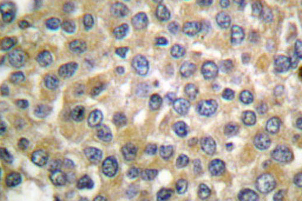 MLANA / Melan-A Antibody - IHC of MART-1/MLANA (P75) pAb in paraffin-embedded human breast carcinoma tissue.