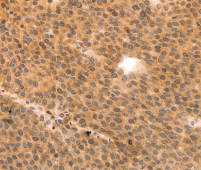 MLC2 / MYL9 Antibody - Immunohistochemistry of paraffin-embedded human liver cancer tissue using MYL9 antibody.