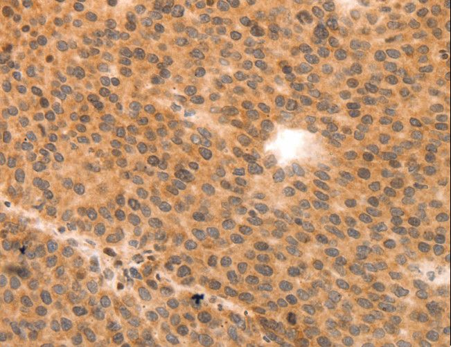MLC2 / MYL9 Antibody - Immunohistochemistry of paraffin-embedded Human liver cancer using MYL9 Polyclonal Antibody at dilution of 1:80.