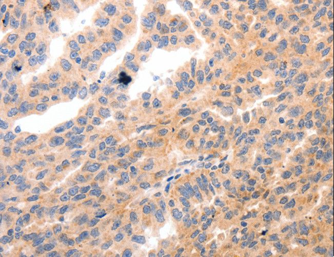 MLC2 / MYL9 Antibody - Immunohistochemistry of paraffin-embedded Human ovarian cancer using MYL9 Polyclonal Antibody at dilution of 1:80.