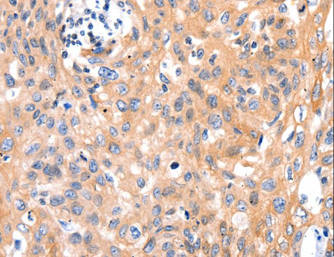 MLC2 / MYL9 Antibody - Immunohistochemistry of paraffin-embedded Human cervical cancer using MYL9 Polyclonal Antibody at dilution of 1:80.