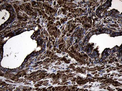 MLC3F / MYL1 Antibody - Immunohistochemical staining of paraffin-embedded Carcinoma of Human prostate tissue using anti-MYL1 mouse monoclonal antibody. (Heat-induced epitope retrieval by 1mM EDTA in 10mM Tris buffer. (pH8.5) at 120°C for 3 min. (1:500)