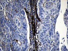 MLC3F / MYL1 Antibody - Immunohistochemical staining of paraffin-embedded Adenocarcinoma of Human endometrium tissue using anti-MYL1 mouse monoclonal antibody. (Heat-induced epitope retrieval by 1mM EDTA in 10mM Tris buffer. (pH8.5) at 120°C for 3 min. (1:500)