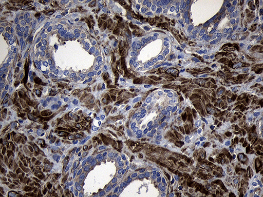 MLC3F / MYL1 Antibody - Immunohistochemical staining of paraffin-embedded Carcinoma of Human prostate tissue using anti-MYL1 mouse monoclonal antibody. (Heat-induced epitope retrieval by 1mM EDTA in 10mM Tris buffer. (pH8.5) at 120°C for 3 min. (1:500)