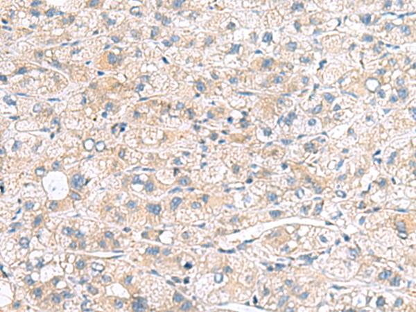 MLC3F / MYL1 Antibody - Immunohistochemistry of paraffin-embedded Human liver cancer tissue  using MYL1 Polyclonal Antibody at dilution of 1:75(×200)