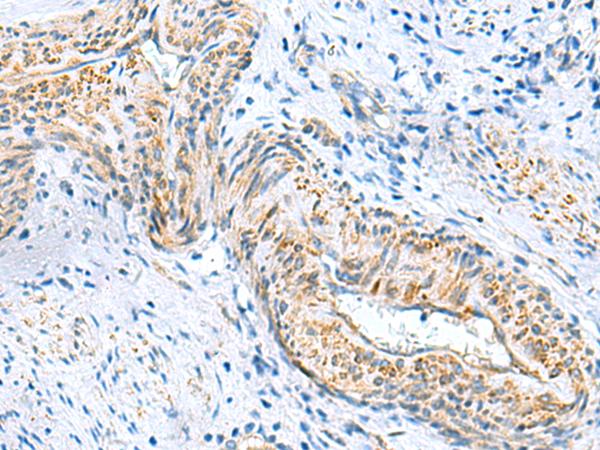 MLC3F / MYL1 Antibody - Immunohistochemistry of paraffin-embedded Human cervical cancer tissue  using MYL1 Polyclonal Antibody at dilution of 1:75(×200)