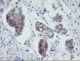 MLF1 Antibody - IHC of paraffin-embedded Carcinoma of Human pancreas tissue using anti-MLF1 mouse monoclonal antibody.