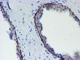 MLF1 Antibody - IHC of paraffin-embedded Carcinoma of Human prostate tissue using anti-MLF1 mouse monoclonal antibody.