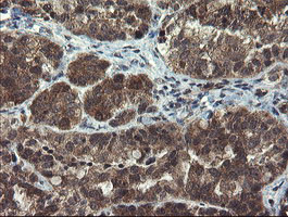 MLF1 Antibody - IHC of paraffin-embedded Adenocarcinoma of Human ovary tissue using anti-MLF1 mouse monoclonal antibody.