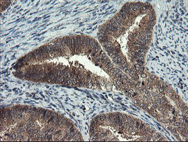MLF1 Antibody - IHC of paraffin-embedded Adenocarcinoma of Human endometrium tissue using anti-MLF1 mouse monoclonal antibody.