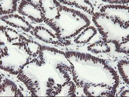MLF1 Antibody - IHC of paraffin-embedded Adenocarcinoma of Human colon tissue using anti-MLF1 mouse monoclonal antibody.