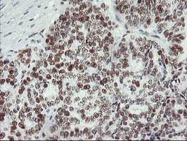 MLF1 Antibody - IHC of paraffin-embedded Adenocarcinoma of Human ovary tissue using anti-MLF1 mouse monoclonal antibody.