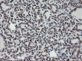 MLF1 Antibody - IHC of paraffin-embedded Carcinoma of Human thyroid tissue using anti-MLF1 mouse monoclonal antibody.