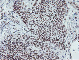 MLF1 Antibody - IHC of paraffin-embedded Carcinoma of Human bladder tissue using anti-MLF1 mouse monoclonal antibody.