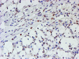 MLF1 Antibody - IHC of paraffin-embedded Carcinoma of Human kidney tissue using anti-MLF1 mouse monoclonal antibody.