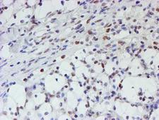MLF1 Antibody - IHC of paraffin-embedded Carcinoma of Human kidney tissue using anti-MLF1 mouse monoclonal antibody.