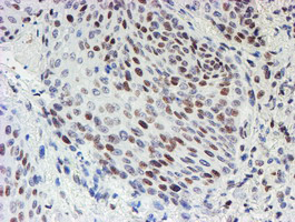 MLF1 Antibody - IHC of paraffin-embedded Carcinoma of Human bladder tissue using anti-MLF1 mouse monoclonal antibody.