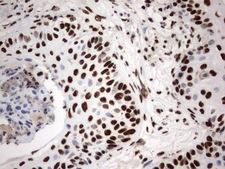 MLF1 Antibody - Immunohistochemical staining of paraffin-embedded Carcinoma of Human lung tissue using anti-MLF1 mouse monoclonal antibody.  heat-induced epitope retrieval by 1 mM EDTA in 10mM Tris, pH8.0, 120C for 3min)