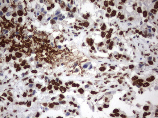 MLF1 Antibody - Immunohistochemical staining of paraffin-embedded Adenocarcinoma of Human ovary tissue using anti-MLF1 mouse monoclonal antibody.  heat-induced epitope retrieval by 1 mM EDTA in 10mM Tris, pH8.0, 120C for 3min)