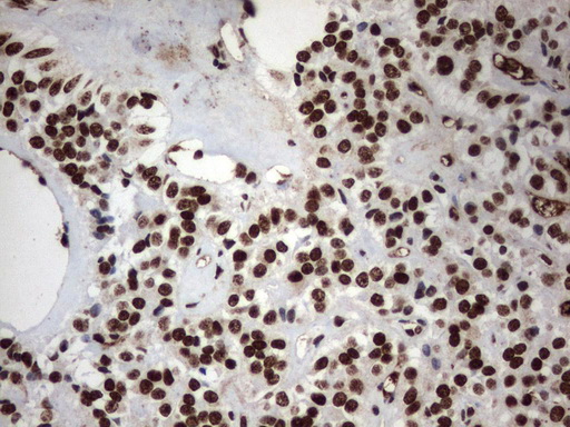 MLF1 Antibody - Immunohistochemical staining of paraffin-embedded Carcinoma of Human pancreas tissue using anti-MLF1 mouse monoclonal antibody.  heat-induced epitope retrieval by 1 mM EDTA in 10mM Tris, pH8.0, 120C for 3min)