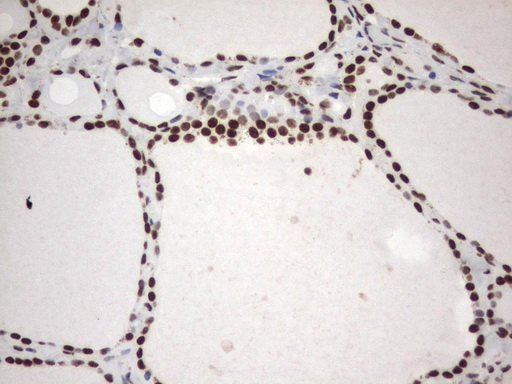 MLF1 Antibody - Immunohistochemical staining of paraffin-embedded Human thyroid tissue using anti-MLF1 mouse monoclonal antibody.  heat-induced epitope retrieval by 1 mM EDTA in 10mM Tris, pH8.0, 120C for 3min)