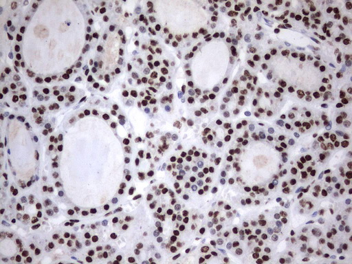 MLF1 Antibody - Immunohistochemical staining of paraffin-embedded Carcinoma of Human thyroid tissue using anti-MLF1 mouse monoclonal antibody.  heat-induced epitope retrieval by 1 mM EDTA in 10mM Tris, pH8.0, 120C for 3min)