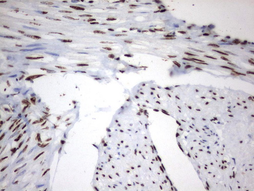 MLF1 Antibody - Immunohistochemical staining of paraffin-embedded Human endometrium tissue using anti-MLF1 mouse monoclonal antibody.  heat-induced epitope retrieval by 1 mM EDTA in 10mM Tris, pH8.0, 120C for 3min)