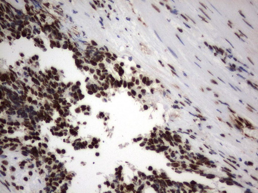 MLF1 Antibody - Immunohistochemical staining of paraffin-embedded Adenocarcinoma of Human endometrium tissue using anti-MLF1 mouse monoclonal antibody.  heat-induced epitope retrieval by 1 mM EDTA in 10mM Tris, pH8.0, 120C for 3min)