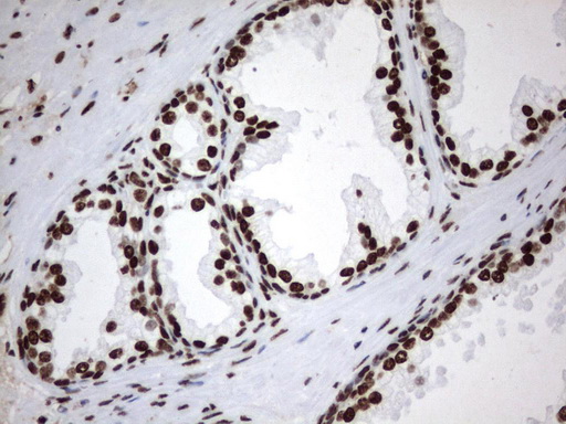 MLF1 Antibody - Immunohistochemical staining of paraffin-embedded Human prostate tissue using anti-MLF1 mouse monoclonal antibody.  heat-induced epitope retrieval by 1 mM EDTA in 10mM Tris, pH8.0, 120C for 3min)