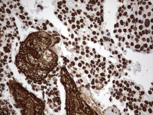 MLF1 Antibody - Immunohistochemical staining of paraffin-embedded Adenocarcinoma of Human breast tissue using anti-MLF1 mouse monoclonal antibody.  heat-induced epitope retrieval by 1 mM EDTA in 10mM Tris, pH8.0, 120C for 3min)
