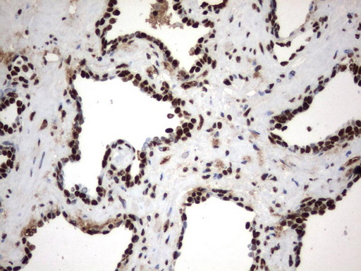 MLF1 Antibody - Immunohistochemical staining of paraffin-embedded Carcinoma of Human prostate tissue using anti-MLF1 mouse monoclonal antibody.  heat-induced epitope retrieval by 1 mM EDTA in 10mM Tris, pH8.0, 120C for 3min)