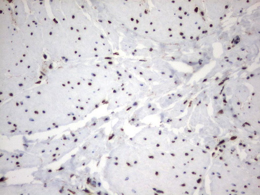 MLF1 Antibody - Immunohistochemical staining of paraffin-embedded Human bladder tissue using anti-MLF1 mouse monoclonal antibody.  heat-induced epitope retrieval by 1 mM EDTA in 10mM Tris, pH8.0, 120C for 3min)