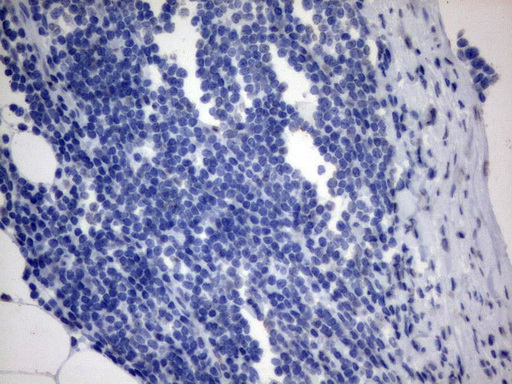 MLF1 Antibody - Immunohistochemical staining of paraffin-embedded Carcinoma of Human bladder tissue using anti-MLF1 mouse monoclonal antibody.  heat-induced epitope retrieval by 1 mM EDTA in 10mM Tris, pH8.0, 120C for 3min)