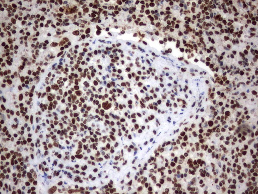 MLF1 Antibody - Immunohistochemical staining of paraffin-embedded Human lymph node tissue using anti-MLF1 mouse monoclonal antibody.  heat-induced epitope retrieval by 1 mM EDTA in 10mM Tris, pH8.0, 120C for 3min)
