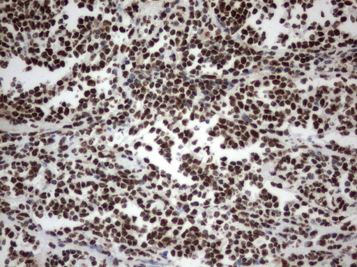 MLF1 Antibody - Immunohistochemical staining of paraffin-embedded Human lymphoma tissue using anti-MLF1 mouse monoclonal antibody.  heat-induced epitope retrieval by 1 mM EDTA in 10mM Tris, pH8.0, 120C for 3min)