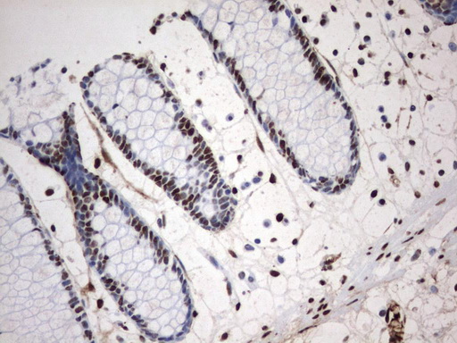 MLF1 Antibody - Immunohistochemical staining of paraffin-embedded Human colon tissue using anti-MLF1 mouse monoclonal antibody.  heat-induced epitope retrieval by 1 mM EDTA in 10mM Tris, pH8.0, 120C for 3min)