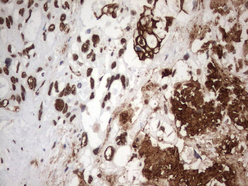 MLF1 Antibody - Immunohistochemical staining of paraffin-embedded Adenocarcinoma of Human colon tissue using anti-MLF1 mouse monoclonal antibody.  heat-induced epitope retrieval by 1 mM EDTA in 10mM Tris, pH8.0, 120C for 3min)