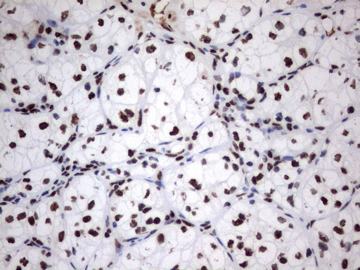 MLF1 Antibody - Immunohistochemical staining of paraffin-embedded Carcinoma of Human kidney tissue using anti-MLF1 mouse monoclonal antibody.  heat-induced epitope retrieval by 1 mM EDTA in 10mM Tris, pH8.0, 120C for 3min)