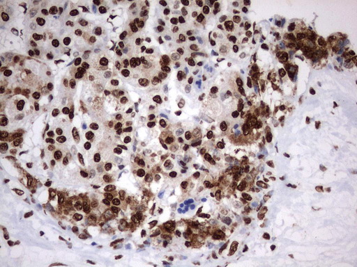 MLF1 Antibody - Immunohistochemical staining of paraffin-embedded Carcinoma of Human liver tissue using anti-MLF1mouse monoclonal antibody.  heat-induced epitope retrieval by 1 mM EDTA in 10mM Tris, pH8.0, 120C for 3min)