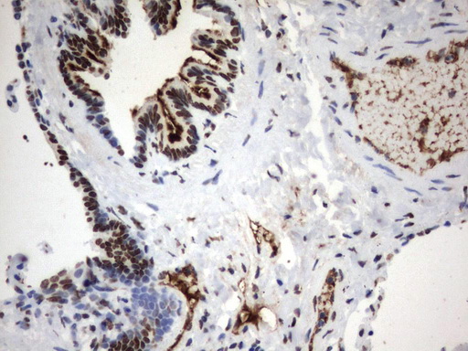 MLF1 Antibody - Immunohistochemical staining of paraffin-embedded Human lung tissue using anti-MLF1 mouse monoclonal antibody.  heat-induced epitope retrieval by 1 mM EDTA in 10mM Tris, pH8.0, 120C for 3min)