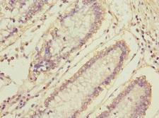 MLF1 Antibody - Immunohistochemistry of paraffin-embedded human colon cancer at dilution 1:100