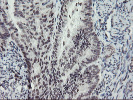 MLF2 Antibody - IHC of paraffin-embedded Adenocarcinoma of Human endometrium tissue using anti-MLF2 mouse monoclonal antibody. (Heat-induced epitope retrieval by 10mM citric buffer, pH6.0, 100C for 10min).