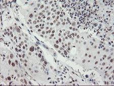 MLF2 Antibody - IHC of paraffin-embedded Carcinoma of Human lung tissue using anti-MLF2 mouse monoclonal antibody. (Heat-induced epitope retrieval by 10mM citric buffer, pH6.0, 100C for 10min).