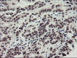 MLF2 Antibody - IHC of paraffin-embedded Adenocarcinoma of Human ovary tissue using anti-MLF2 mouse monoclonal antibody. (Heat-induced epitope retrieval by 10mM citric buffer, pH6.0, 100C for 10min).