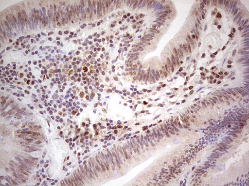 MLH1 Antibody - IHC of paraffin-embedded Adenocarcinoma of Human colon tissue using anti-MLH1 mouse monoclonal antibody. (heat-induced epitope retrieval by 1 mM EDTA in 10mM Tris, pH8.5, 120°C for 3min).