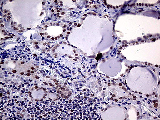 MLH1 Antibody - Immunohistochemical staining of paraffin-embedded Human thyroid tissue within the normal limits using anti-MLH1 mouse monoclonal antibody. (Heat-induced epitope retrieval by 1mM EDTA in 10mM Tris buffer. (pH8.5) at 120°C for 3 min. (1:1000)