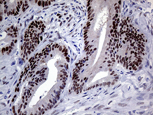 MLH1 Antibody - Immunohistochemical staining of paraffin-embedded Adenocarcinoma of Human colon tissue using anti-MLH1 mouse monoclonal antibody. (Heat-induced epitope retrieval by 1mM EDTA in 10mM Tris buffer. (pH8.5) at 120°C for 3 min. (1:1000)